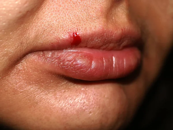 Rachadura no lábio. Sangue no lábio superior — Fotografia de Stock