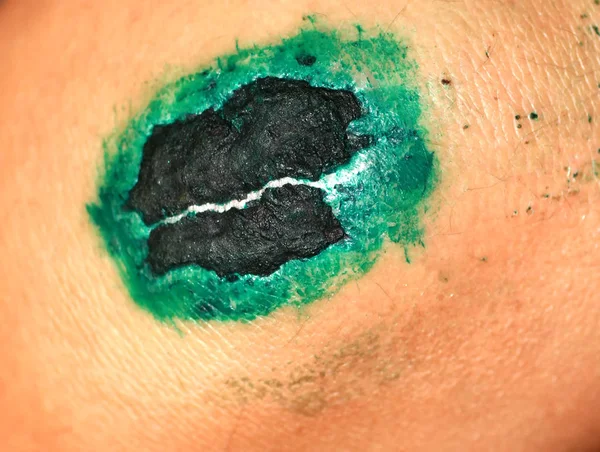 Healing wound on the knee. The wound treated with brilliant green. The scab will climb