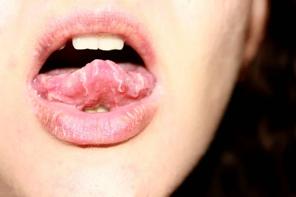 Zorzal en la lengua del niño. Candida — Foto de Stock