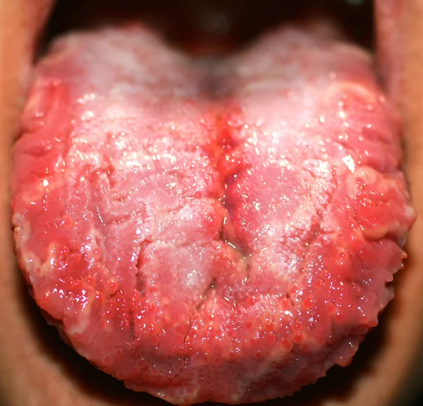 Geographic tongue, candidiasis, the language of the white coating candida — 图库照片