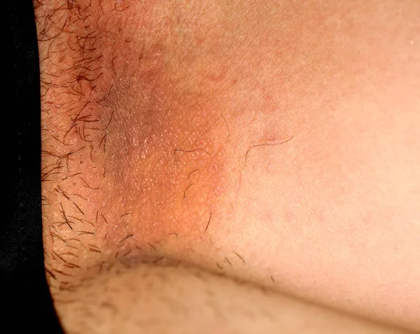 Infecção fúngica na virilha, Psoríase, dermatite, eczema . — Fotografia de Stock