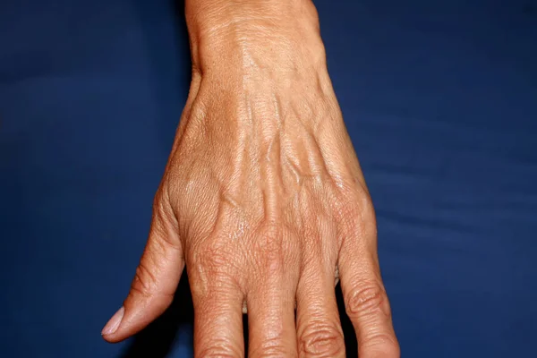 Old hand. Arm with large bulging veins. — Stock Photo, Image