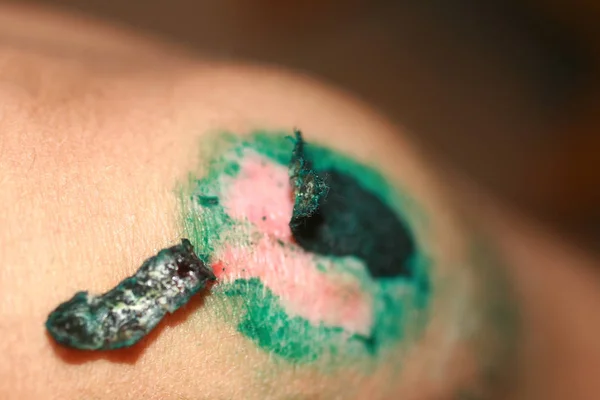 Ferida cicatrizante no joelho. A ferida tratada com verde brilhante. A crosta vai subir. — Fotografia de Stock
