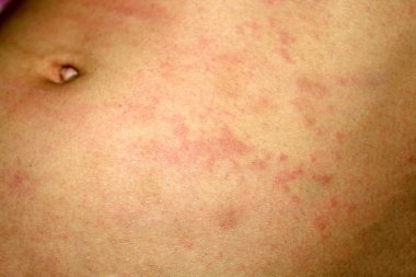 Pink lichen on the skin of the abdomen. Psoriasis, dermatitis, eczema, urticaria, allergies. clipart
