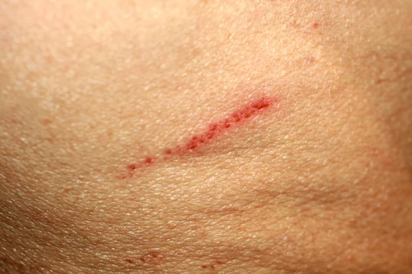 Wound cut on the skin. Abrasion on human skin. — Stock Photo, Image