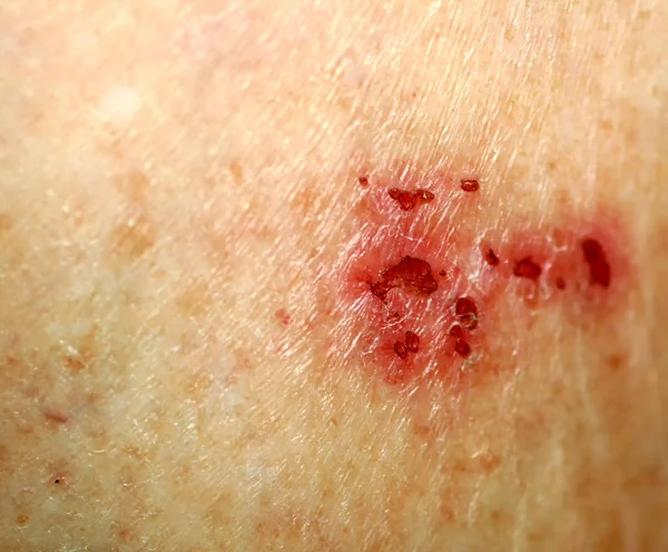 Wond op de huid. Psoriasis, dermatitis, eczeem. — Stockfoto