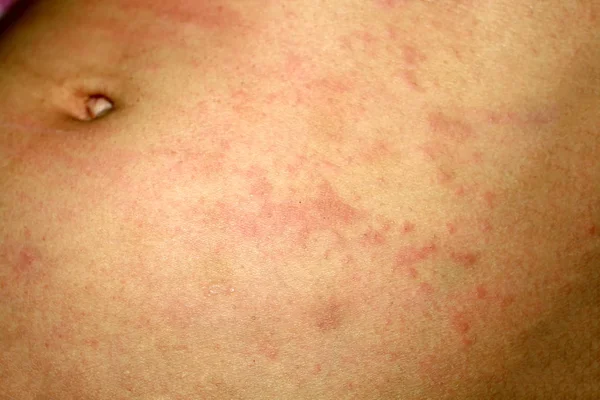 Różowy liszaj na skórze brzucha. Łuszczyca, zapalenie skóry, wyprysk, pokrzywka, alergie. — Zdjęcie stockowe