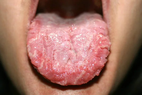지리적 혀, 칸디 다, 백색 코팅 칸디 다의 언어 — 스톡 사진