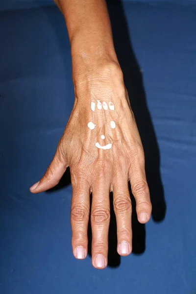 Old hand. Arm with large bulging veins. Applying a healing cream on the hand in the form of a smile. — Stock Photo, Image