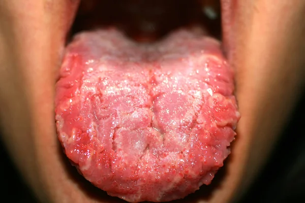 Geographic tongue, candidiasis, the language of the white coating candida — 图库照片