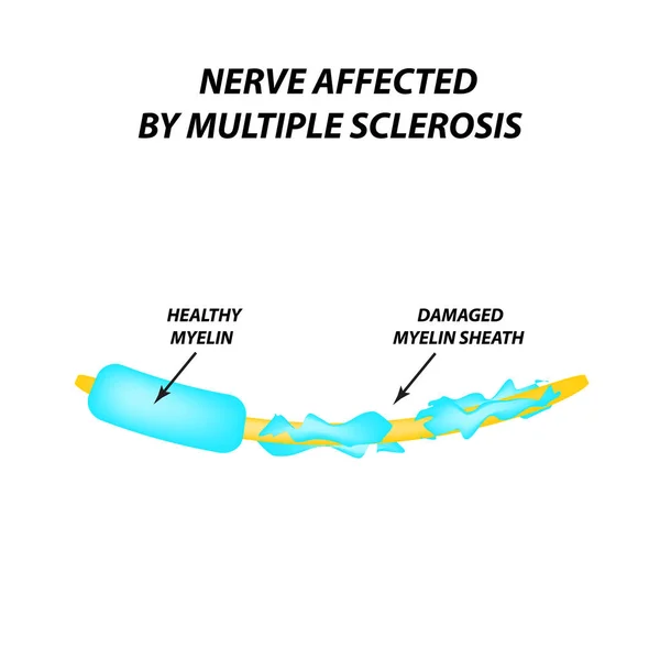 La distruzione della guaina mielinica sull'assone. Mielina danneggiata. Neurone affetto da sclerosi multipla. Giornata mondiale della sclerosi multipla. Infografica. Illustrazione vettoriale su sfondo isolato . — Vettoriale Stock