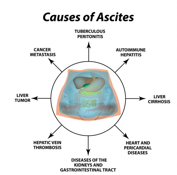 Ascites fri vätska i bukhålan. Infographics. Vektorillustration på isolerade bakgrund. — Stock vektor