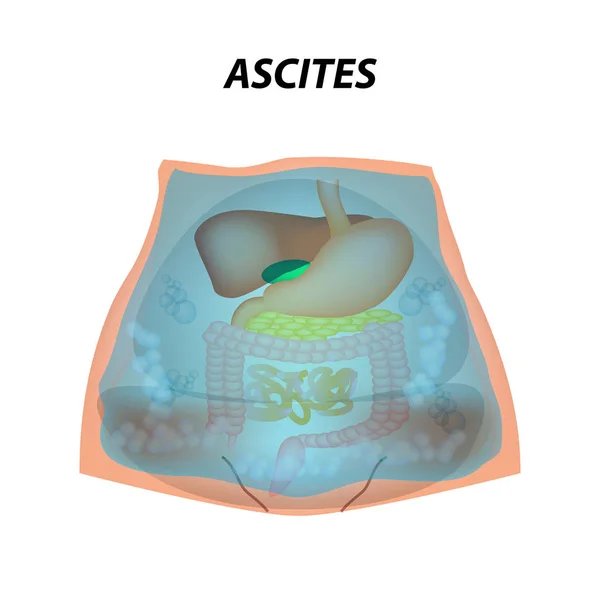 Asit karın boşluğunda sıvı birikmesi. Infographics. Vektör illüstrasyon izole arka plan üzerinde. — Stok Vektör