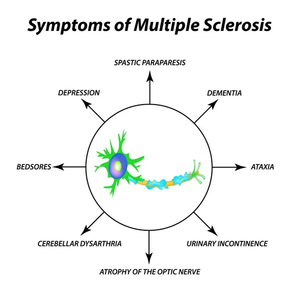 Sclerosis multiplex tüneteit. A myelin hüvely, axon a pusztulását. Sérült myelin. Sclerosis multiplex világnapja. Infographics. Elszigetelt háttér vektor illusztráció. — Stock Vector
