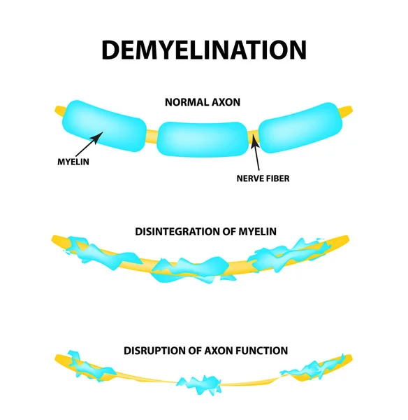 A destruição da bainha de mielina no axônio. Mielina danificada. Neuron afetado pela esclerose múltipla. Dia Mundial da esclerose múltipla. Infográficos. Ilustração vetorial sobre fundo isolado . —  Vetores de Stock