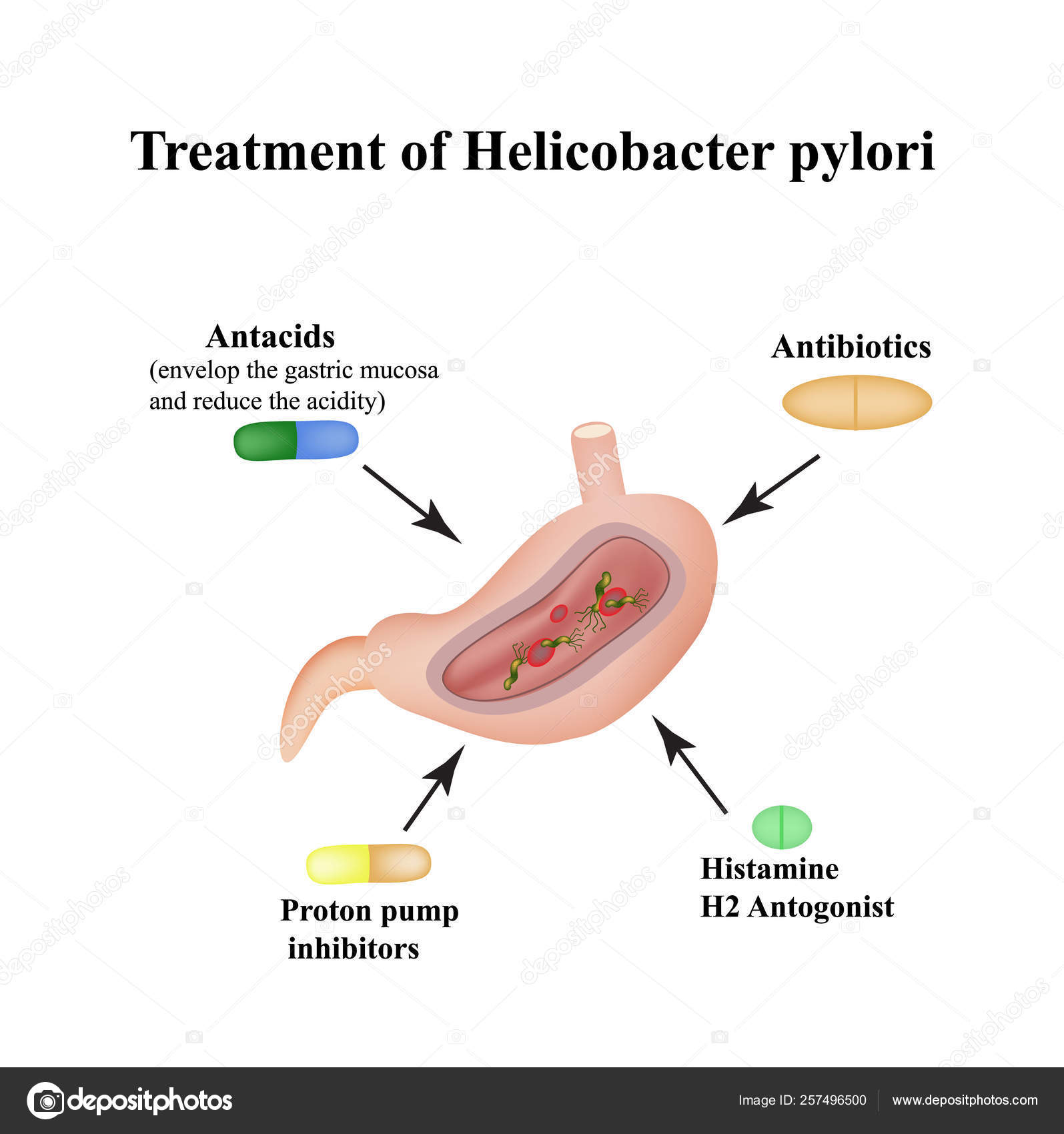 Traitement de Helicobacter pylori. Des médicaments. Antiacides, inhibiteurs de la pompe à