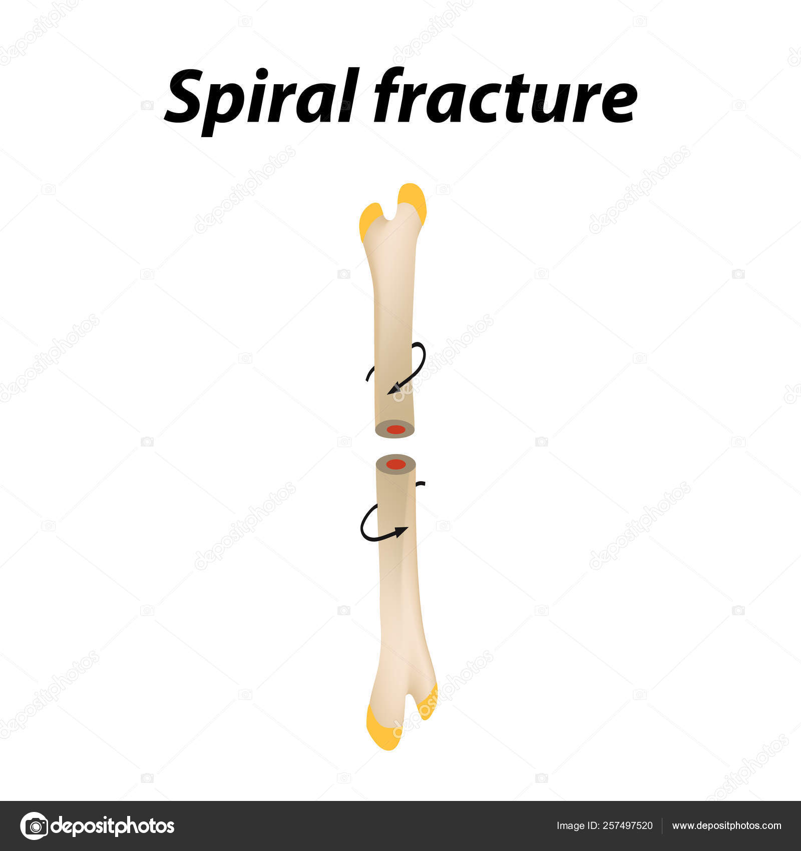 Spiral Bone Fracture. Infographics. Vector illustration on a lined