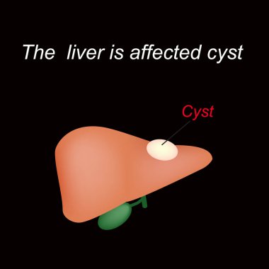 Karaciğerde bir kist. Karaciğer kist etkilenir. Siyah arka planda vektör çizimi