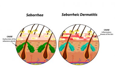 Causes Seborrhea skin and hair. Dandruff seborrheic dermatitis. Eczema. Dysfunction of the sebaceous glands. Inflammatory skin disease. Anatomical structure. Infographics. Vector illustration clipart