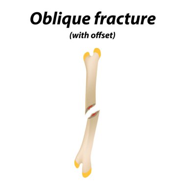 Eğik sapma kemik kırığı olan. Infographics. Vektör çizim çizgili bir arka plan üzerinde.