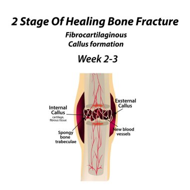 2 Stage Of Healing Bone Fracture. Formation of callus. The bone fracture. Infographics. Vector illustration on isolated background. clipart