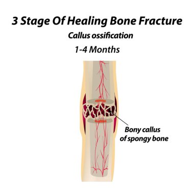 3 Stage Of Healing Bone Fracture. callus ossification. The bone fracture. Infographics. Vector illustration on isolated background. clipart