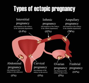 Rahim fibroidtürleri. Endometriozis. ınfographics. Siyah arka planda vektör çizimi