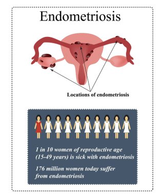 Endometriozis. Endometrial kistler. Yalıtılmış vektör çizimi