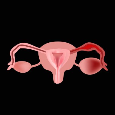 Salpingitis. Fallop tüpü iltihabı. Oofhorit. yumurtalık. pelvik organlar. Infographics Vektör illüstrasyon