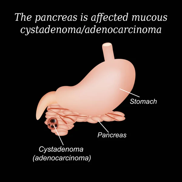 Cistadenoma mucoso del páncreas, adenocarcinoma. Ilustración vectorial sobre fondo negro — Vector de stock