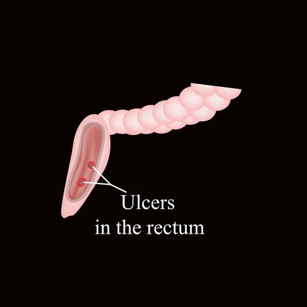 Una úlcera en el recto. Úlceras en los intestinos. Ilustración vectorial sobre fondo negro — Vector de stock