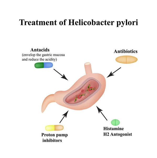 Behandlung von Helicobacter pylori. Medikamente. Antazida, Protonenpumpenblocker und h2-Histaminblocker. Infografiken. Vektor-Illustration auf isoliertem Hintergrund — Stockvektor