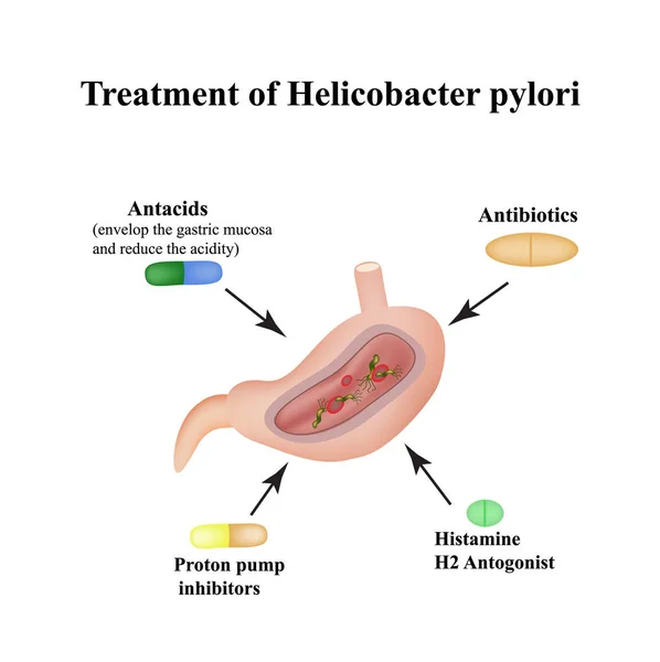 Tratamiento de Helicobacter pylori. Medicamentos. Antiácidos, bloqueadores de bomba de protones y bloqueadores de histamina H2. Infografías. Ilustración vectorial sobre fondo aislado — Archivo Imágenes Vectoriales