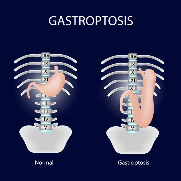 Gastroptose no estômago. A omissão do estômago. Gastroptose em fase. Ilustração vetorial —  Vetores de Stock