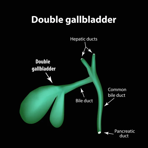 Doble vesícula biliar. Patología de la vesícula biliar. Colecistitis. La estructura de la vesícula biliar. Infografías. Ilustración vectorial — Vector de stock