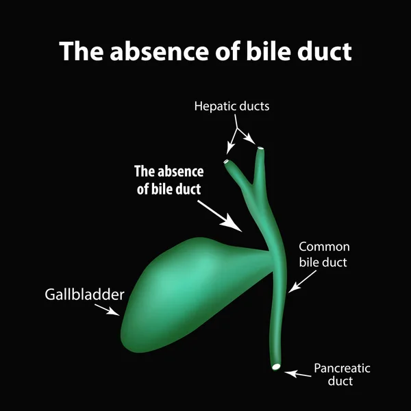 Frånvaron av gallgången. Patologi i gallblåsan. Kolecystit. Strukturen i gallblåsan. Infographics. Vektor illustration — Stock vektor