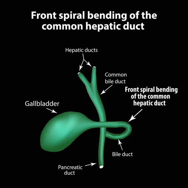 Doble espiral frontal del conducto hepático común. Patología de la vesícula biliar. Colecistitis. La estructura de la vesícula biliar. Infografías. Ilustración vectorial — Vector de stock