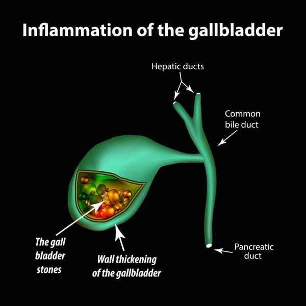 Epekő. Cholelithiasis. Cholecystitis. Gyulladás az epehólyag. Infographics. Vektoros illusztráció — Stock Vector