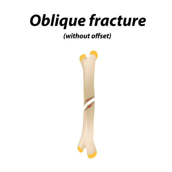 Oblique, sem fractura óssea compensada. Infográficos. Ilustração vetorial sobre fundo forrado . — Vetor de Stock