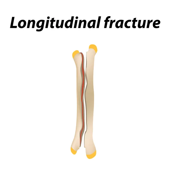 Złamania kości wzdłużnej. Infografiki. Ilustracja wektorowa na tle podszewką. — Wektor stockowy