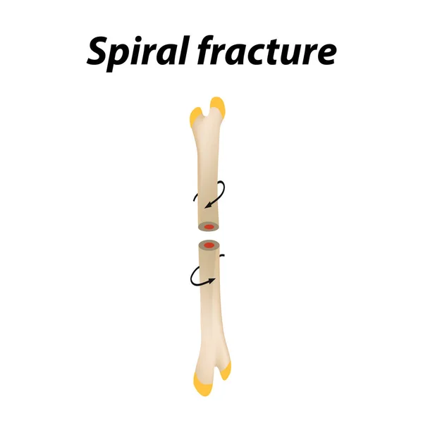 Спиральный перелом кости. Инфографика. Векторная иллюстрация на подкладке . — стоковый вектор
