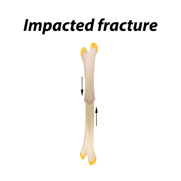 Fratura provocada Osso. Infográficos. Ilustração vetorial sobre fundo forrado . —  Vetores de Stock