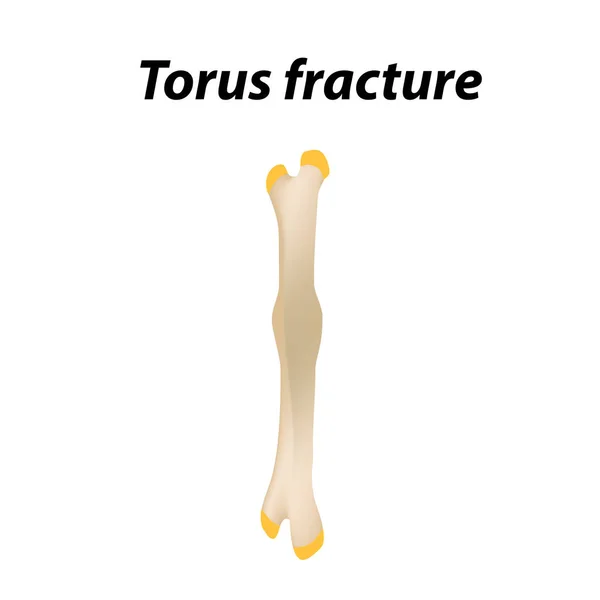Torus złamania kości. Infografiki. Ilustracja wektorowa na tle podszewką. — Wektor stockowy
