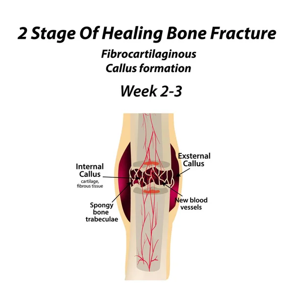 2 etap gojenia złamań kości. Powstawanie kalusa. Złamania kości. Infografiki. Ilustracja wektorowa na na białym tle. — Wektor stockowy
