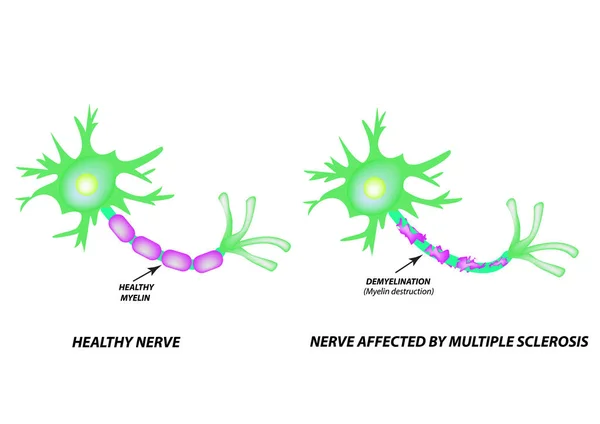 La destrucción de la vaina de mielina en el axón. Mielina dañada. Neurón afectado por esclerosis múltiple. Día Mundial de Esclerosis Múltiple. Infografías. Ilustración vectorial sobre fondo aislado . — Vector de stock