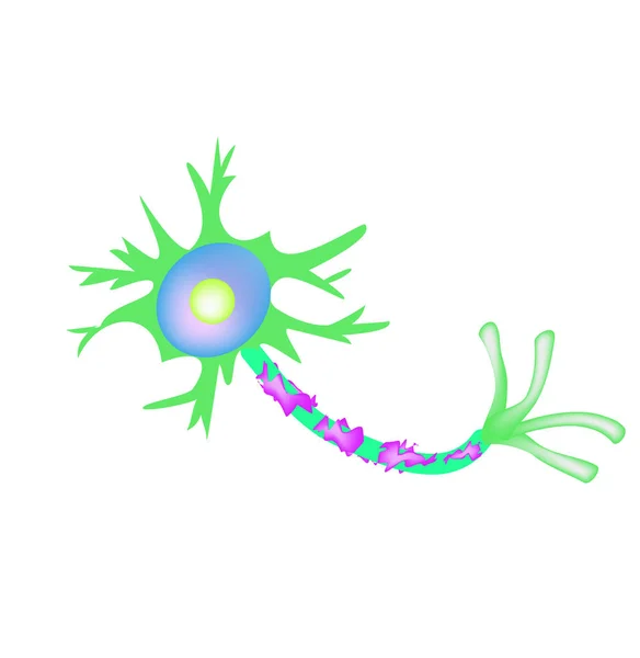 A destruição da bainha de mielina no axônio. Mielina danificada. Neuron afetado pela esclerose múltipla. Dia Mundial da esclerose múltipla. Infográficos. Ilustração vetorial sobre fundo isolado . — Vetor de Stock