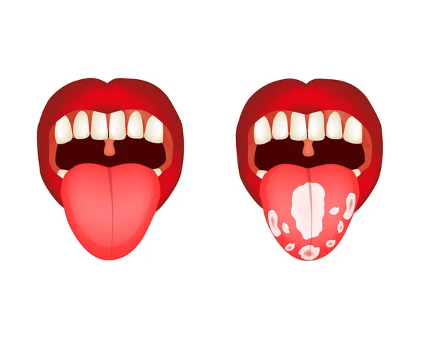 Candidiasis av tungan, trast. Inflammation i tungan. Infographics. Vektor illustration på isolerad bakgrund. — Stock vektor