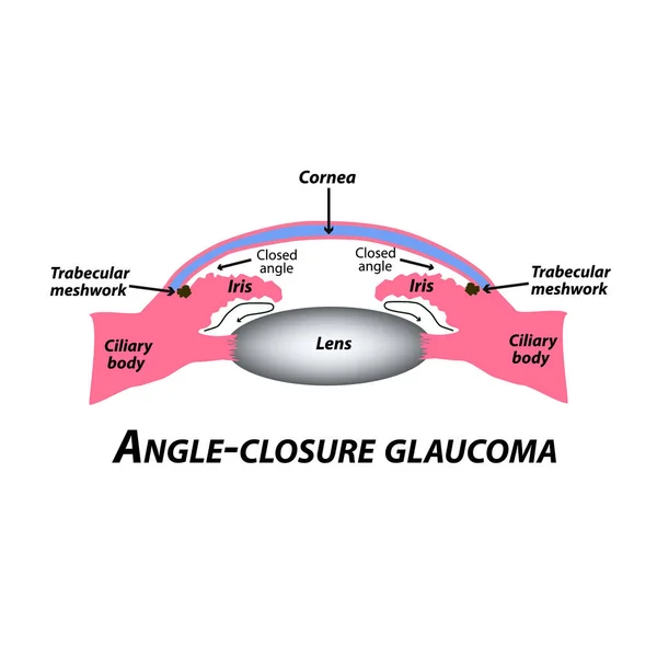 Glaucoma ad angolo chiuso. Un tipo comune di glaucoma. La struttura anatomica dell'occhio. Infografica. Illustrazione vettoriale su sfondo isolato . — Vettoriale Stock