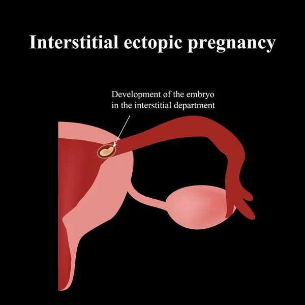 Entwicklung des Embryos in der interstitiellen Abteilung. Ektopische Schwangerschaft. Infografiken. Vektorillustration — Stockvektor