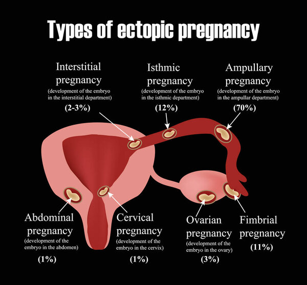 Types of uterine fibroids. Endometriosis. Infographics. Vector illustration on a black background